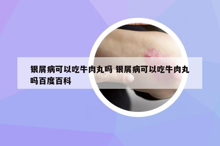 銀屑病可以吃牛肉丸嗎 銀屑病可以吃牛肉丸嗎百度百科